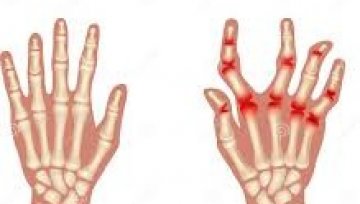 Moderate to Severe Rheumatoid Arthritis: An Advanced Clinical Framework